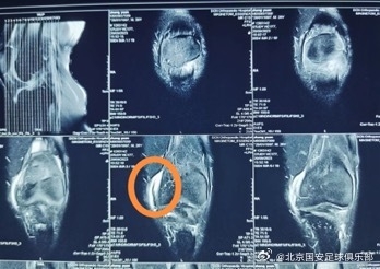 张源左膝伤情分析